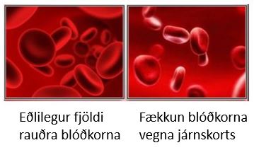 blodleysi jarnskortur
